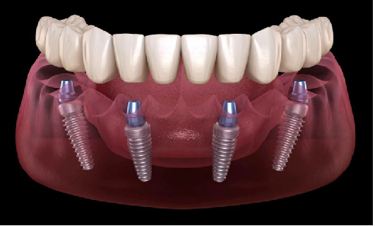 Dört implant üzerine tam çene sabit protez (All-on-4)