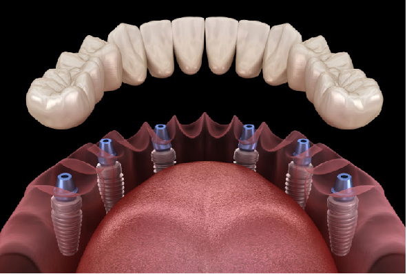 Altı implant üzerine tam çene sabit protez (All-on-6)