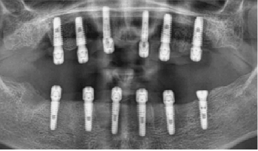 Üst ve alt çenede implantları gösteren panoramik röntgen