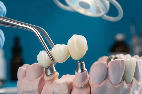 Model üzerinde implant destekli köprü
